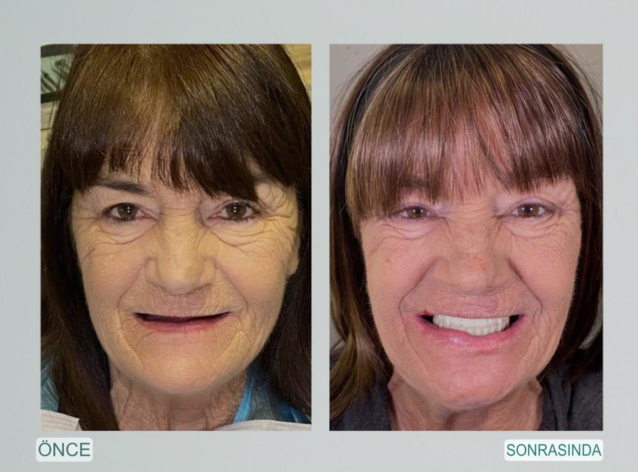 Denture Pluss™ 🦷Gelişmiş Kişiye Özel Tam Protez Seti🦷