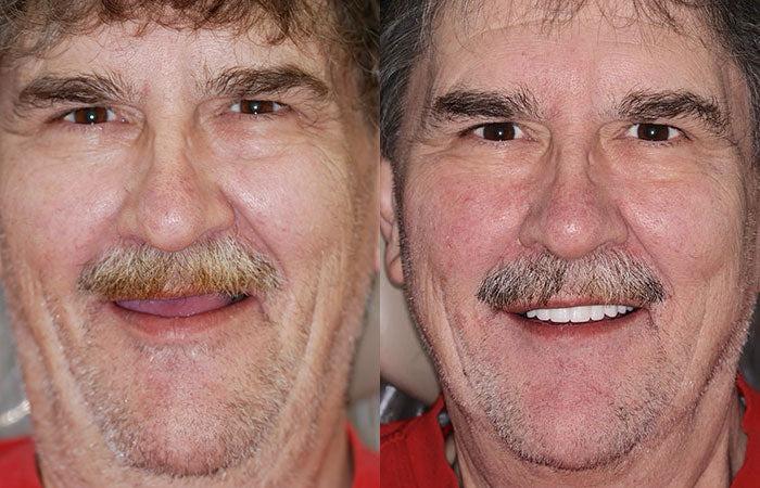 Denture Pluss™ 🦷Gelişmiş Kişiye Özel Tam Protez Seti🦷