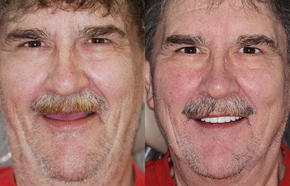 Denture Pluss™ 🦷Gelişmiş Kişiye Özel Tam Protez Seti🦷